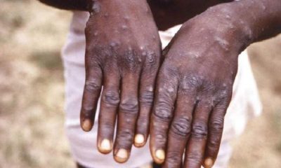 First case of monkeypox registered in Monroe County